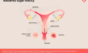 Ilustracja przedstawia anatomię kobiecych narządów rozrodczych z zaznaczoną nadżerką szyjki macicy, która jest wrzodziejącym ubytkiem.