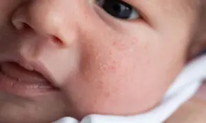 Alergia u niemowlaka: jak rozpoznać objawy i pomóc dziecku?