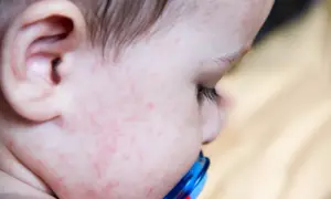 Alergia pokarmowa u dziecka: Pełna lista objawów i co dalej?