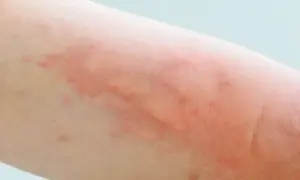 Pokrzywka alergiczna: zobacz zdjęcia, poznaj objawy i leczenie