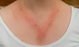 Alergia skórna: Zdjęcia i objawy. Rozpoznaj, kiedy iść do lekarza