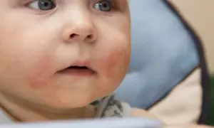 Alergia na jajka u niemowląt: objawy. Jak rozpoznać i pomóc?