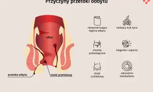 Ilustracja przedstawia anatomię odbytu z widoczną przetoką odbytu. Obok ikony symbolizujące przyczyny: zła higiena, siedzący tryb życia, choroby proktologiczne, biegunka i zaparcia, otwór przetokowy, zaburzenia metabolizmu.