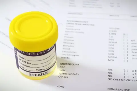 Pojemnik na mocz i wyniki badań laboratoryjnych, które mogą pomóc w ocenie, jakie badania na nerki są potrzebne.