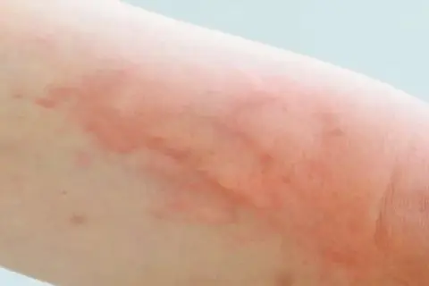 Pokrzywka alergiczna: zobacz zdjęcia, poznaj objawy i leczenie
