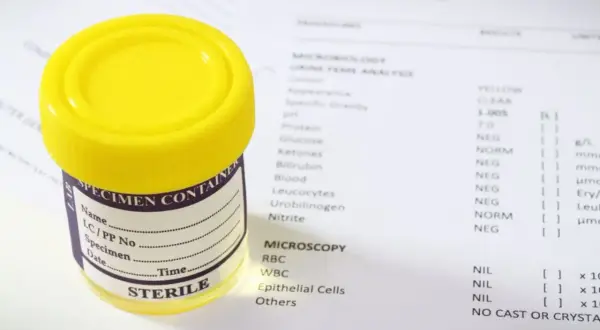 Pojemnik na mocz i wyniki badań laboratoryjnych, które mogą pomóc w ocenie, jakie badania na nerki są potrzebne.