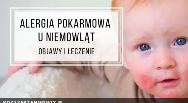 Alergia pokarmowa: objawy. Jak rozpoznać i kiedy działać?