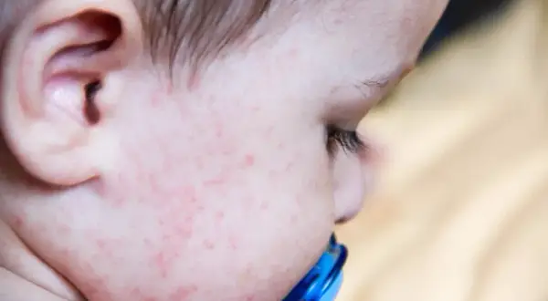 Alergia pokarmowa u dziecka: Pełna lista objawów i co dalej?