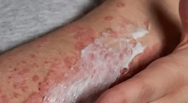 Alergia: Jak rozpoznać, leczyć i żyć bez objawów? Pełny przewodnik