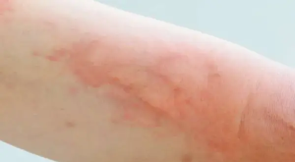 Pokrzywka alergiczna: zobacz zdjęcia, poznaj objawy i leczenie