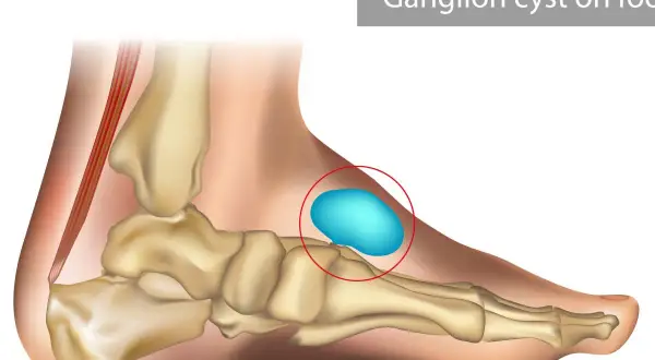 Anatomia stopy z widocznym ganglion na stopie, zaznaczonym czerwonym okręgiem.