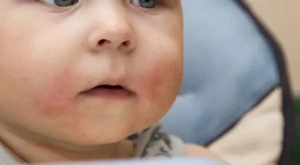Alergia na jajka u niemowląt: objawy. Jak rozpoznać i pomóc?