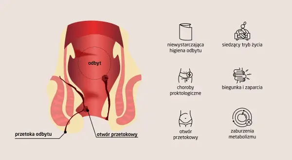 Ilustracja przedstawia anatomię odbytu z widoczną przetoką odbytu. Obok ikony symbolizujące przyczyny: zła higiena, siedzący tryb życia, choroby proktologiczne, biegunka i zaparcia, otwór przetokowy, zaburzenia metabolizmu.