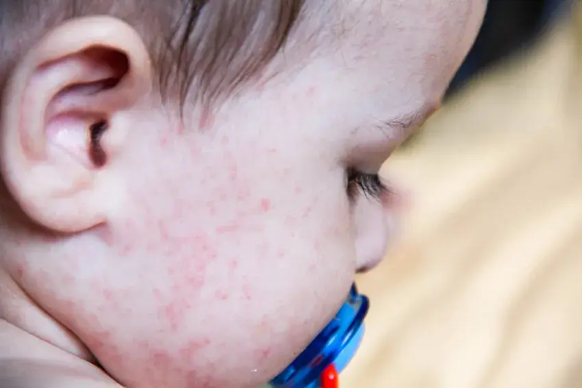 Alergia pokarmowa u dziecka: Pełna lista objawów i co dalej?