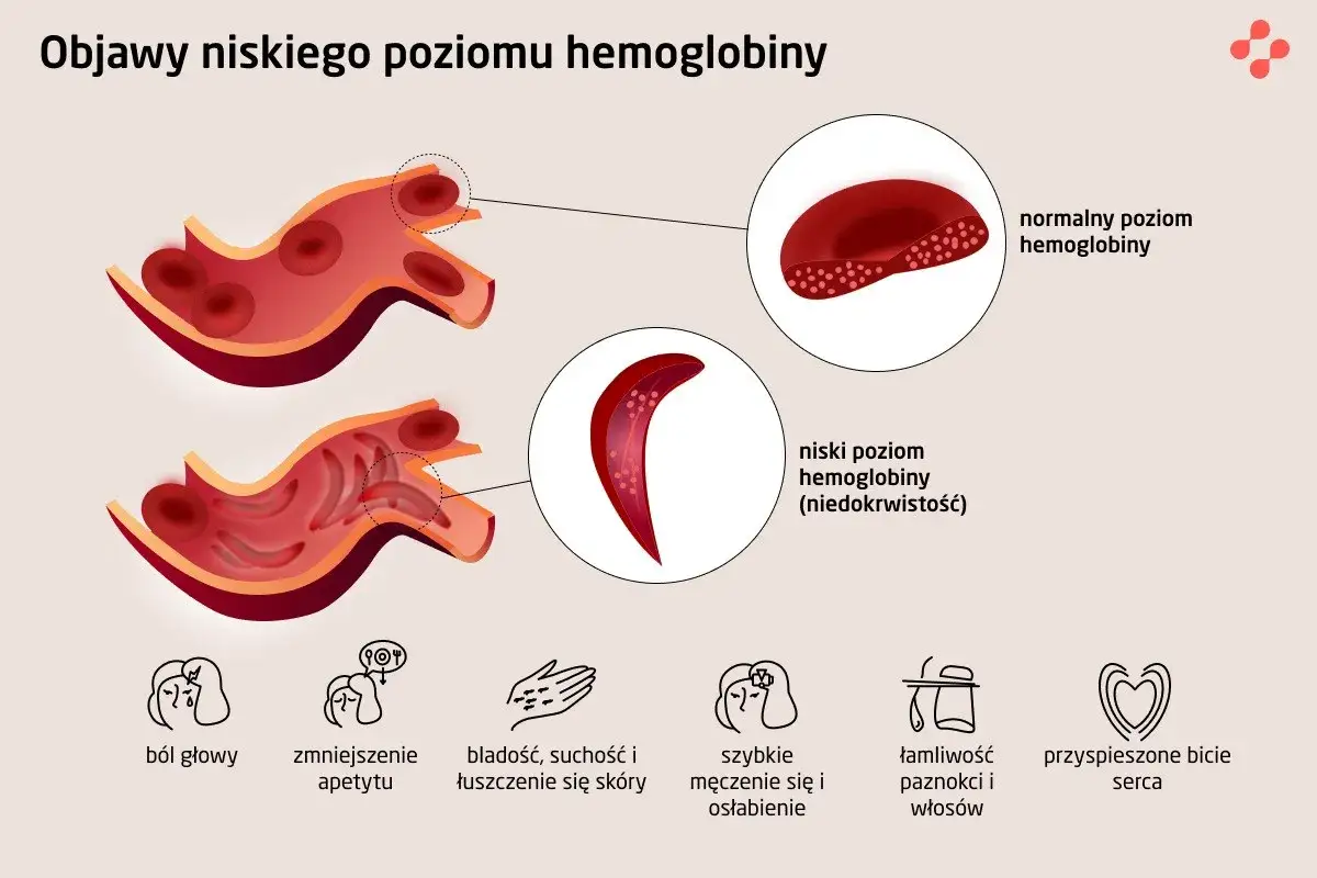 Ilustracja pokazuje, jak niski poziom hemoglobiny wpływa na kształt czerwonych krwinek, powodując objawy niedokrwistości. Norma hemoglobiny zapewnia prawidłowe funkcjonowanie.