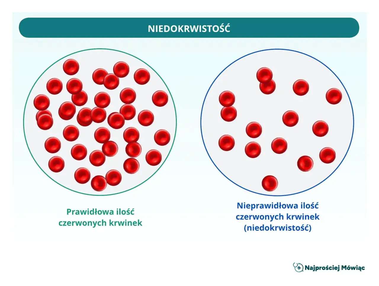 Porównanie prawidłowej ilości czerwonych krwinek z ich niedoborem (niedokrwistość). Wskaźnik rdw-sd może pomóc w ocenie.