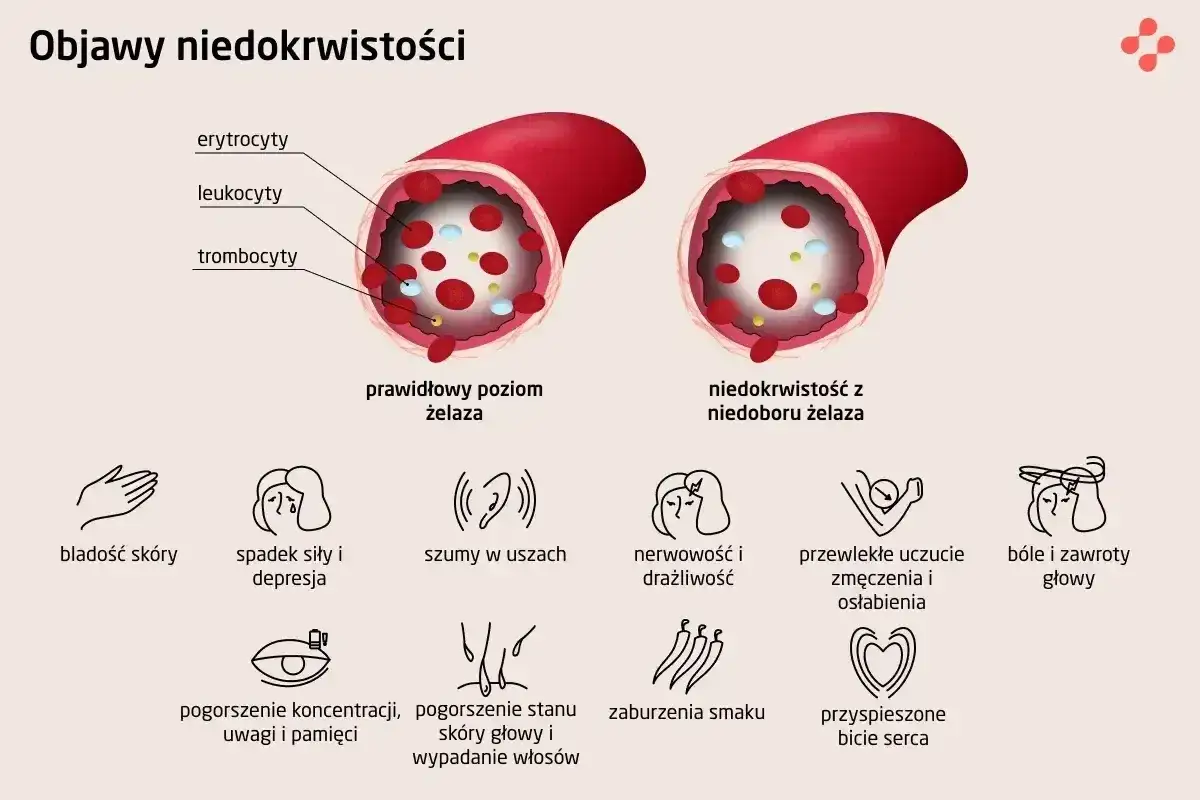 Porównanie poziomu żelaza we krwi: prawidłowy vs. niedobór. Objawy anemii: bladość, zmęczenie, szumy w uszach, bóle głowy, problemy z koncentracją, wypadanie włosów. Niski hgb może być przyczyną.