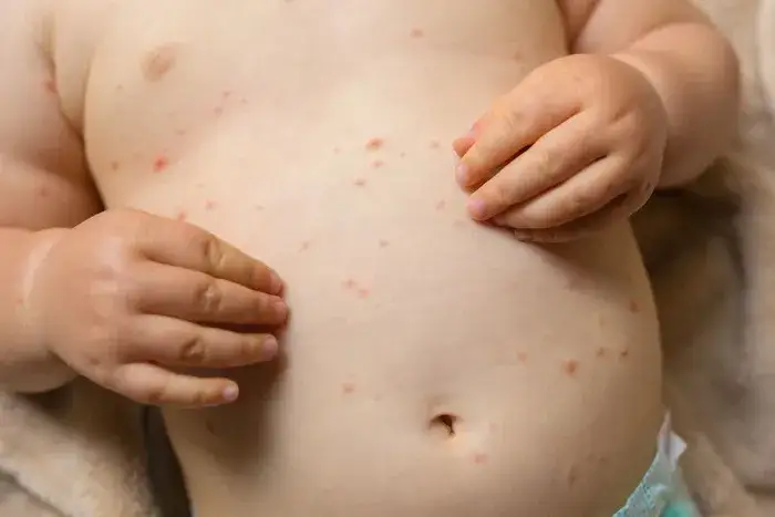 Różne rodzaje wysypek alergicznych u niemowląt