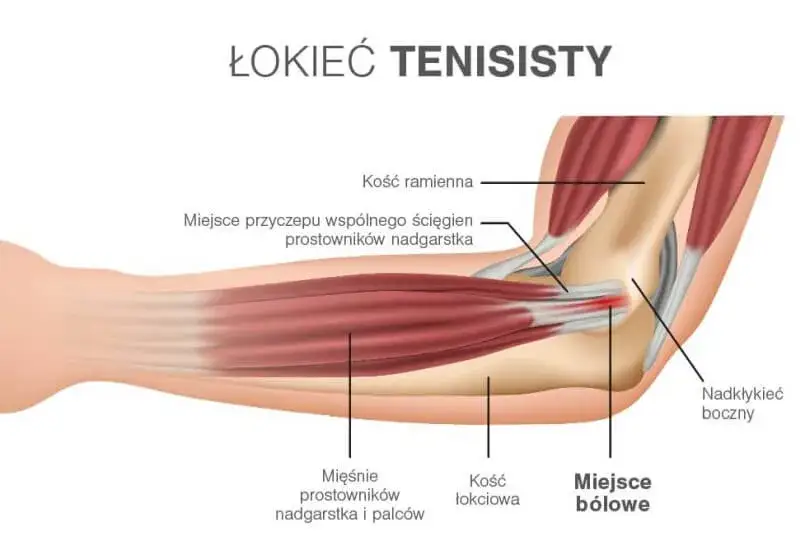 łokieć tenisisty i łokieć golfisty ilustracja
