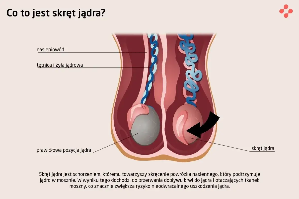 Zapalenie najądrza objawy