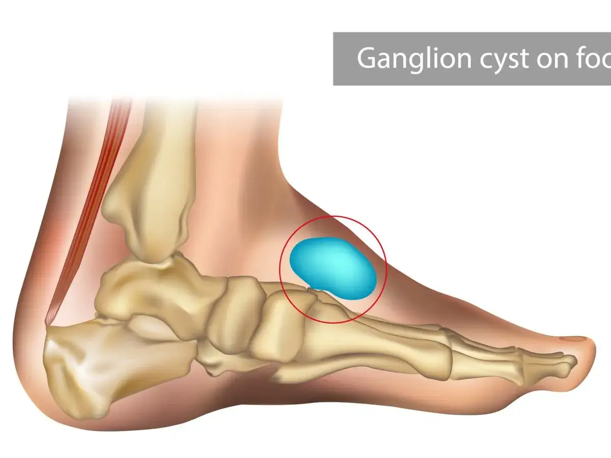 Anatomia stopy z widocznym ganglionem na grzbiecie, zaznaczonym czerwonym okręgiem.