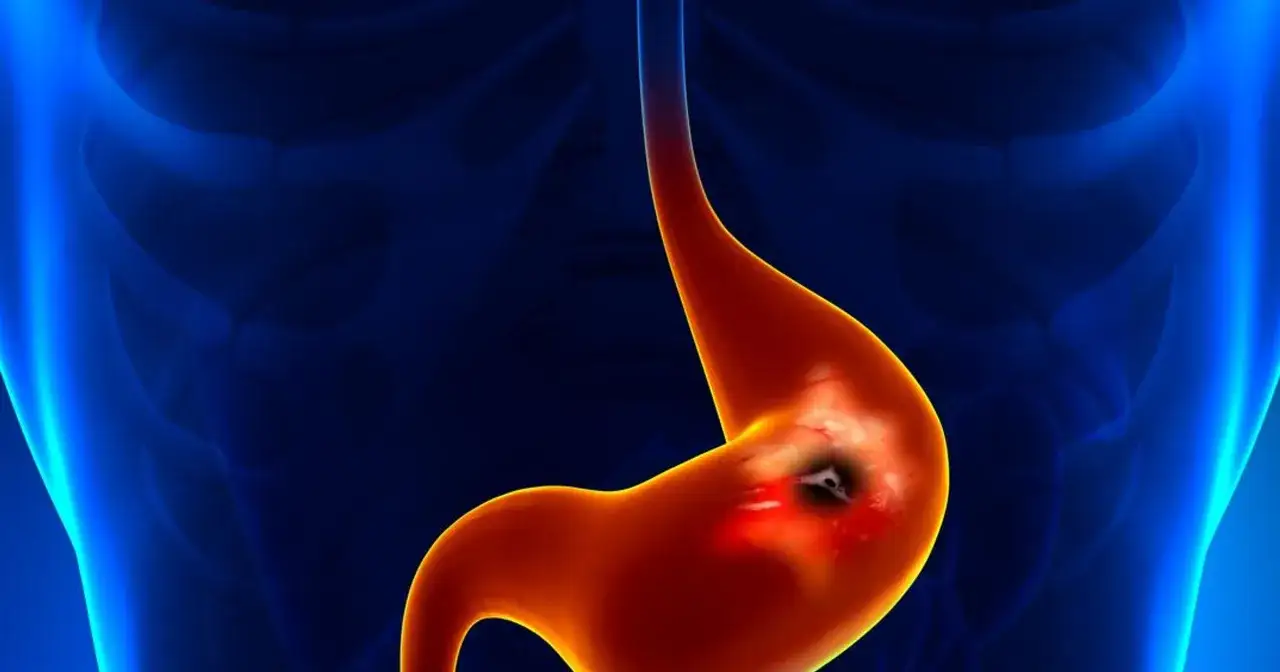 Żołądek z owrzodzeniem, być może spowodowanym przez bakterię Helicobacter pylori.