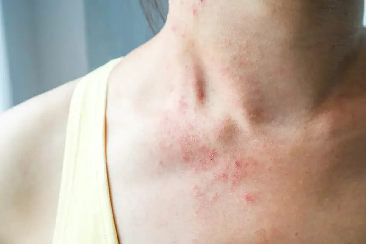 Skórne objawy alergii na pleśń
