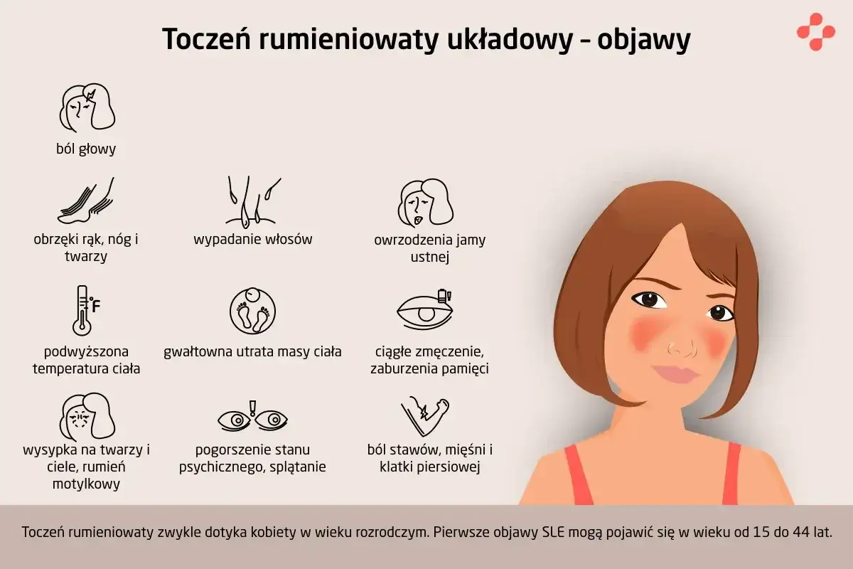 Objawy tocznia: ból głowy, obrzęki, wypadanie włosów, owrzodzenia, gorączka, utrata wagi, zmęczenie, wysypka, problemy psychiczne, bóle stawów.