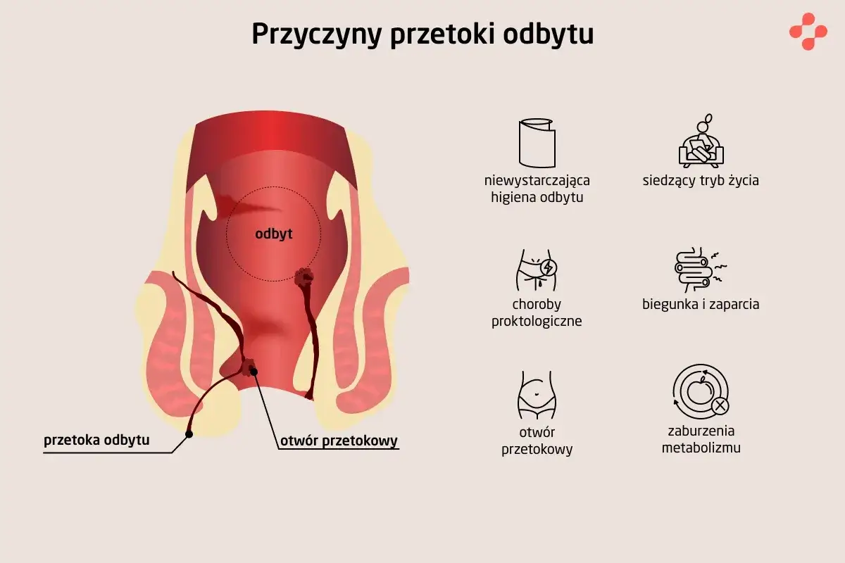 Ilustracja przedstawia anatomię odbytu z widoczną przetoką odbytu. Obok ikony symbolizujące przyczyny: zła higiena, siedzący tryb życia, choroby proktologiczne, biegunka i zaparcia, otwór przetokowy, zaburzenia metabolizmu.