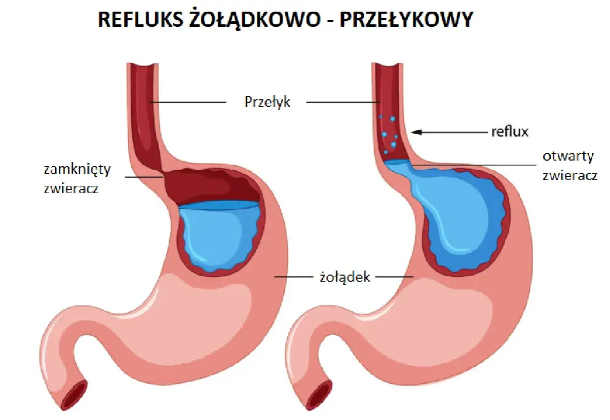 Schemat refluksu żołądkowo-przełykowego: po lewej zamknięty zwieracz, po prawej otwarty zwieracz i cofanie się treści żołądkowej.