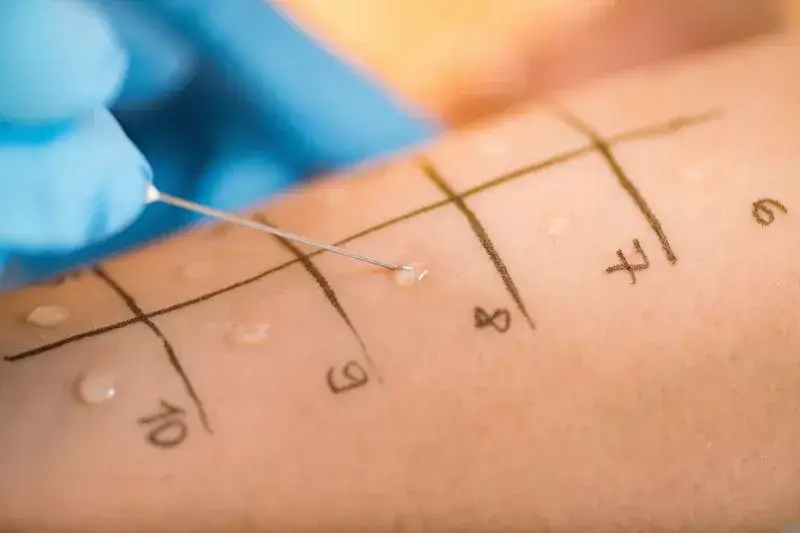 diagnostyka alergii testy skórne