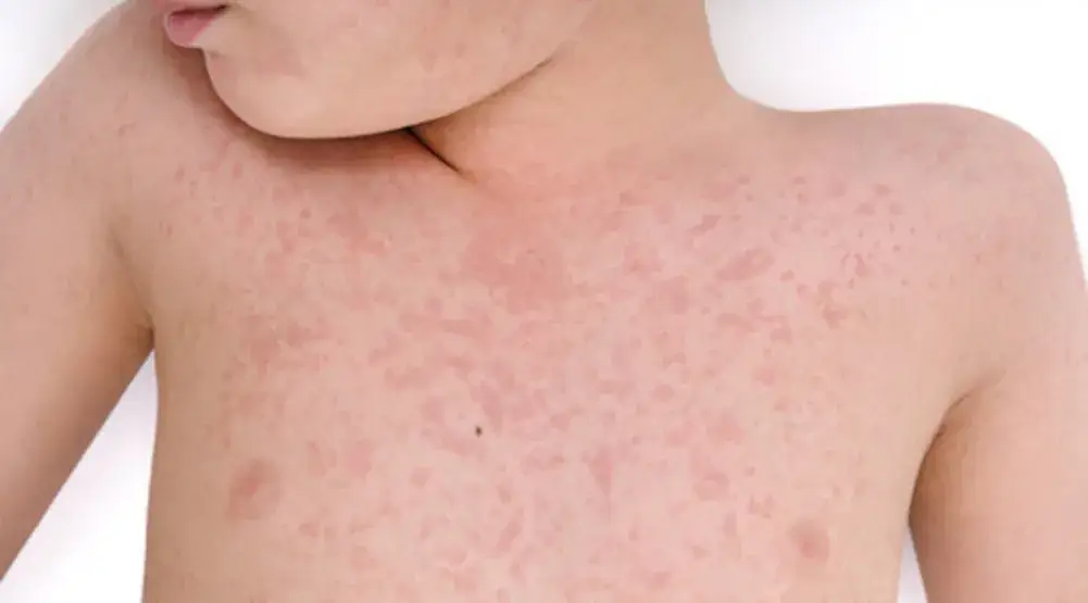 Alergia pokarmowa objawy skórne