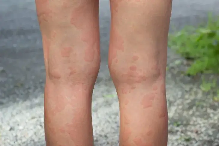 pokrzywka alergiczna na ręce i nogach