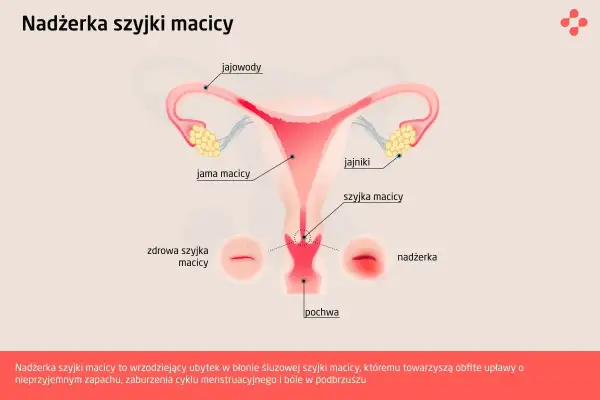 Ilustracja przedstawia anatomię kobiecych narządów rozrodczych z zaznaczoną nadżerką szyjki macicy, która jest wrzodziejącym ubytkiem.