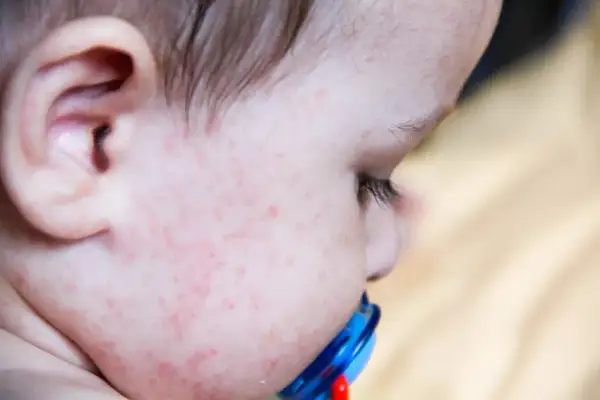 Alergia pokarmowa u dziecka: Pełna lista objawów i co dalej?