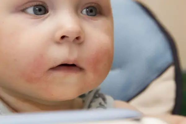 Alergia na jajka u niemowląt: objawy. Jak rozpoznać i pomóc?