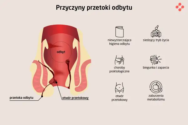 Ilustracja przedstawia anatomię odbytu z widoczną przetoką odbytu. Obok ikony symbolizujące przyczyny: zła higiena, siedzący tryb życia, choroby proktologiczne, biegunka i zaparcia, otwór przetokowy, zaburzenia metabolizmu.